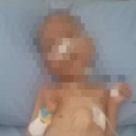 Miris Banget ! Bocah Gizi Buruk di Parungpanjang Meninggal, Tak Terdaftar BPJS PBI
